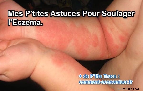 Effective Tips to Relieve Eczema Itching: Practical Advice from Real Experience