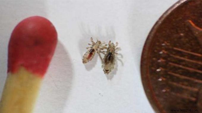 Eliminate Head Lice Naturally: Proven Homemade Remedy with Vinegar and Mouthwash