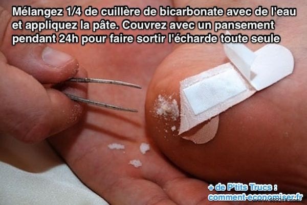 Proven Home Remedy: Remove Deep Splinters Easily with Baking Soda