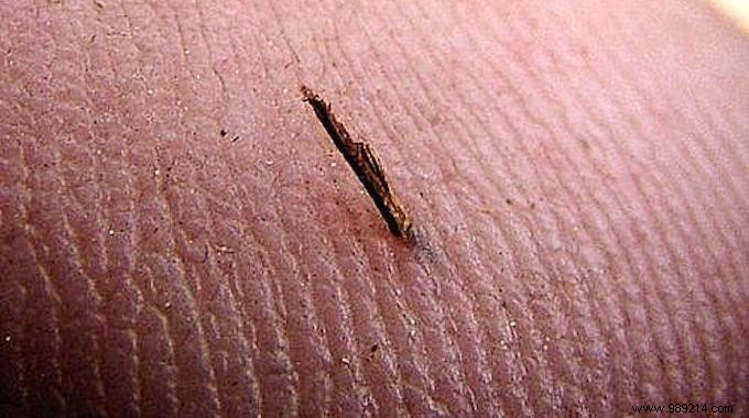 Proven Home Remedy: Remove Deep Splinters Easily with Baking Soda