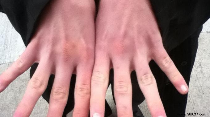 Soothe Red, Irritated Hands from Cold Weather: My Grandmother s Proven Natural Remedy