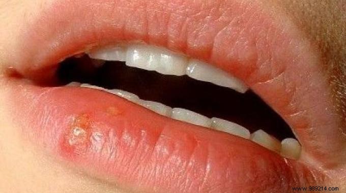 3 Proven Natural Remedies to Quickly Heal Cold Sores