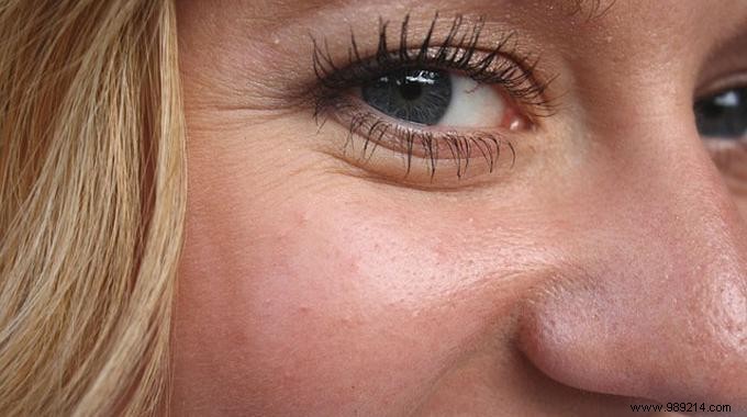 DIY Blackhead Patches: My Simple Homemade Recipe for Clear, Pore-Free Skin