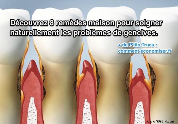 8 Proven Natural Remedies for Relieving Gum Disease at Home