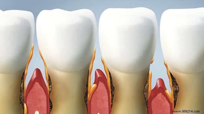 8 Proven Natural Remedies for Relieving Gum Disease at Home