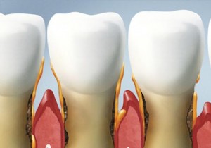 8 Proven Natural Remedies for Relieving Gum Disease at Home