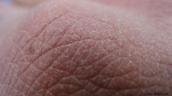 Grandma s Time-Tested Natural Remedy for Severely Dry Skin