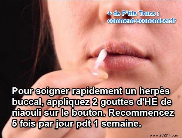 Proven Natural Remedy for Oral Herpes: Niaouli Essential Oil for Fast Relief