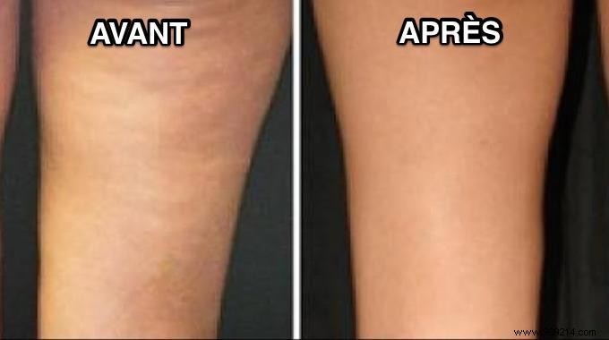 Natural Lemon Water: A Simple Way to Reduce Cellulite