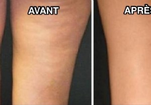 Natural Lemon Water: A Simple Way to Reduce Cellulite