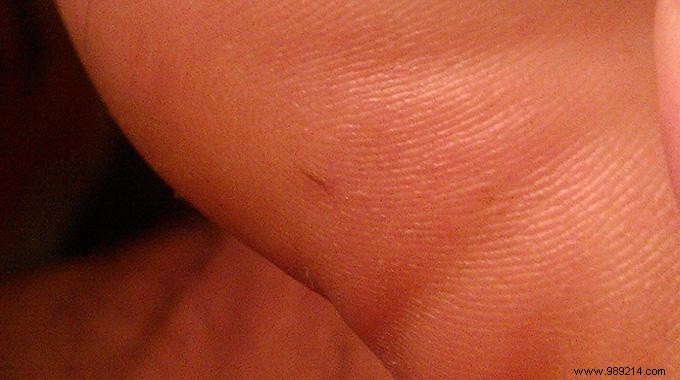 Painless Splinter Removal: Proven Home Remedy for Foot, Finger, or Hand