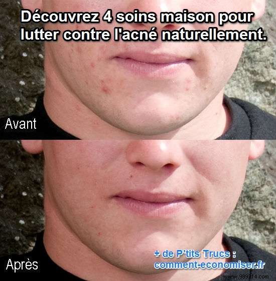 4 Proven Natural Home Remedies to Fight Acne: My Personal Experience