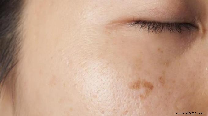 13 Proven Natural Remedies to Fade Dark Spots on Skin