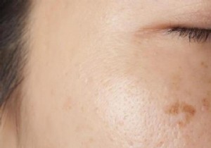 13 Proven Natural Remedies to Fade Dark Spots on Skin