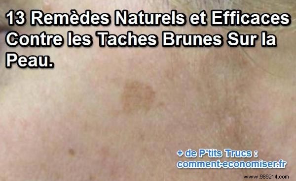 13 Proven Natural Remedies to Fade Dark Spots on Skin