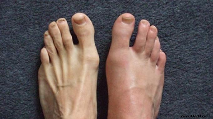 Relieve Gout Attacks Naturally: The Power of Potato Cooking Water