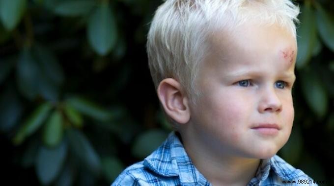 Heal Bruises Fast: Proven Lemon Ice Compress Remedy