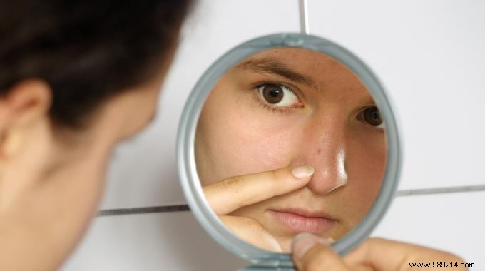 Banish Teen Acne with Baking Soda: Simple Natural Spot Treatment
