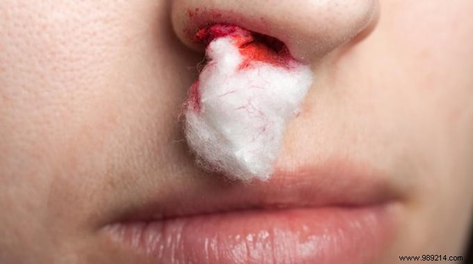 Stop Nosebleeds Fast: Simple Lemon Juice Remedy Backed by Natural Healing Properties