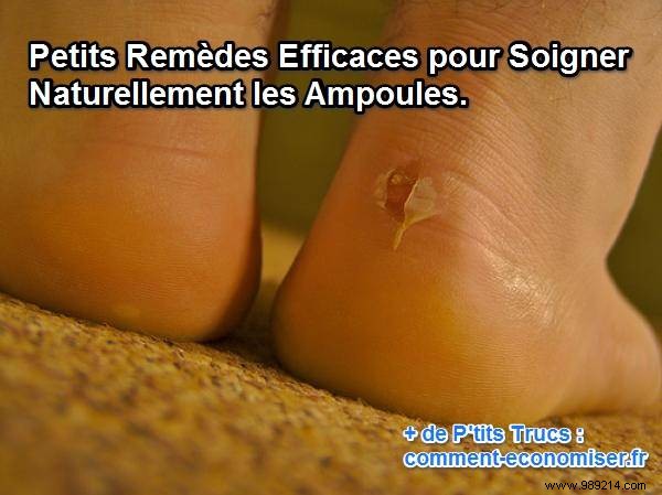 Effective Home Remedies to Treat and Prevent Foot Blisters Naturally