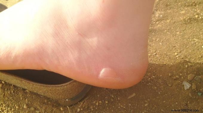 Effective Home Remedies to Treat and Prevent Foot Blisters Naturally