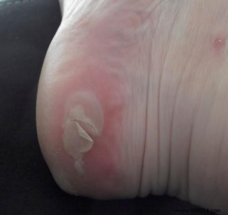 Effective Home Remedies to Treat and Prevent Foot Blisters Naturally