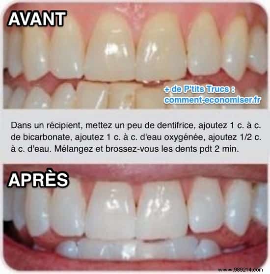 Effective Home Teeth Whitening: Dentist-Recommended Baking Soda and Hydrogen Peroxide Method