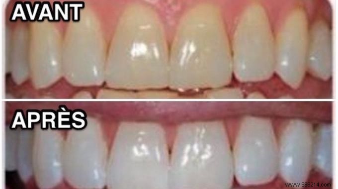 Effective Home Teeth Whitening: Dentist-Recommended Baking Soda and Hydrogen Peroxide Method