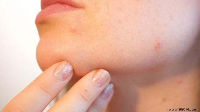 Aspirin Acne Mask: A Proven Home Remedy for Clearer Skin