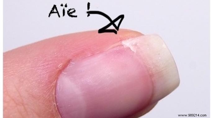Easy DIY Guide: Repair a Broken Nail in Minutes Using a Tea Bag