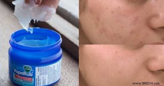 18 Proven Vicks VapoRub Uses for Coughs, Pain Relief, Skin Care, and More