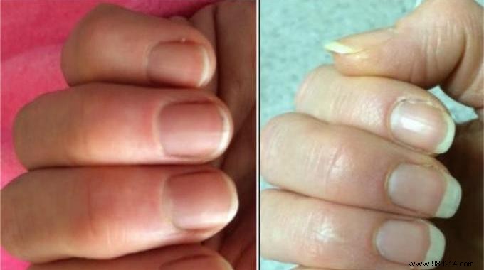 Grandma s Proven Garlic Remedy: Grow Stronger, Longer Nails Faster