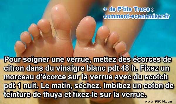 Painless Natural Remedy for Plantar Warts: Lemon, Vinegar & Cedar Tincture