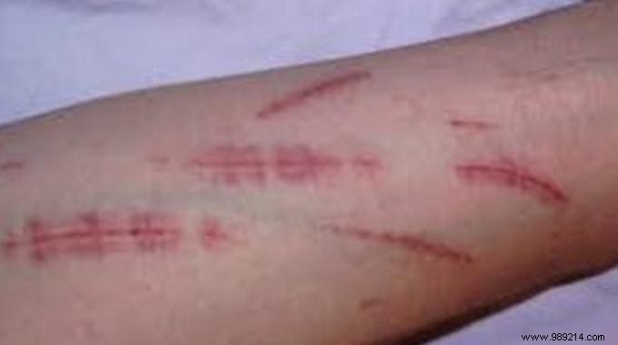 Lemon Juice: A Time-Tested Natural Antiseptic for Minor Wounds