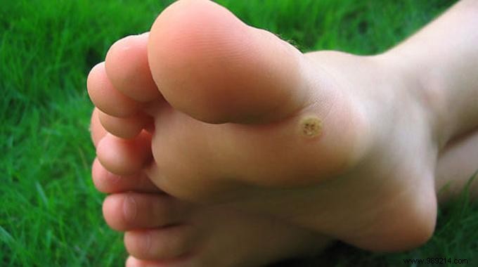 How to Remove Warts Naturally Using Garlic: A Time-Tested Home Remedy