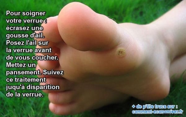 How to Remove Warts Naturally Using Garlic: A Time-Tested Home Remedy