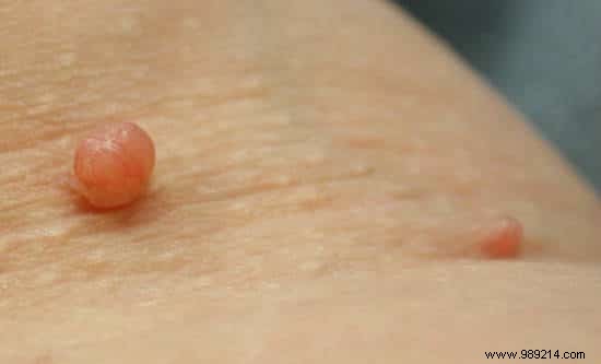 How to Safely Remove Skin Tags Naturally with Apple Cider Vinegar