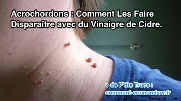 How to Safely Remove Skin Tags Naturally with Apple Cider Vinegar