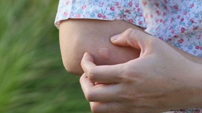 Fast Relief for Insect Bites: Baking Soda and Vinegar Home Remedy