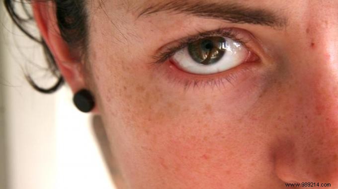 3 Proven Natural Remedies to Quickly Relieve Styes