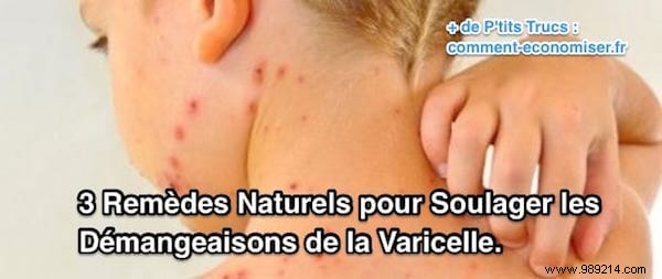 3 Proven Natural Remedies to Soothe Chickenpox Itch in Children