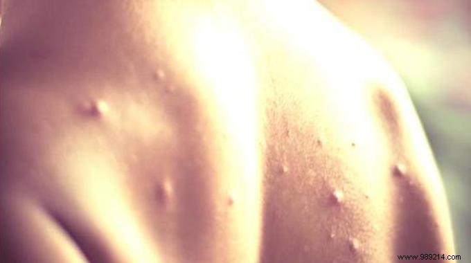 3 Proven Natural Remedies to Soothe Chickenpox Itch in Children