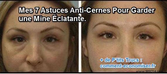 7 Expert Natural Remedies to Banish Dark Circles and Restore Radiant Eyes