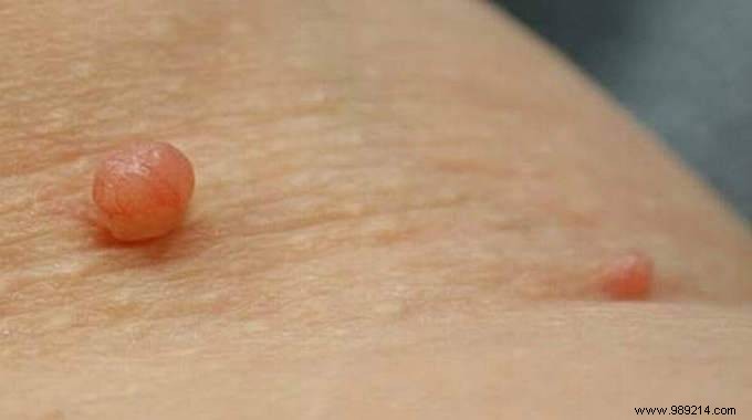 How to Safely Remove Skin Tags at Home with Tea Tree Oil