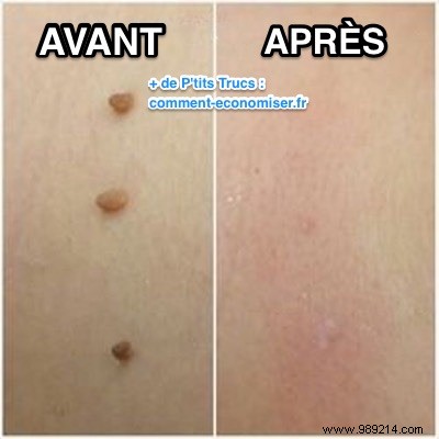 How to Safely Remove Skin Tags at Home with Tea Tree Oil