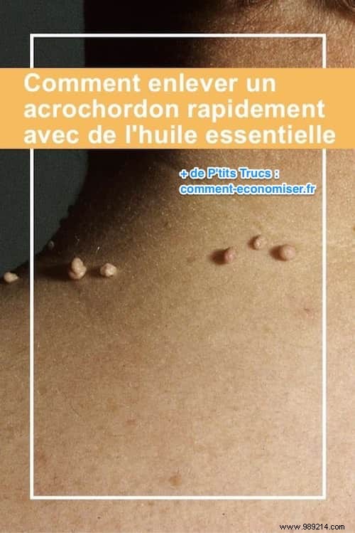 How to Safely Remove Skin Tags at Home with Tea Tree Oil