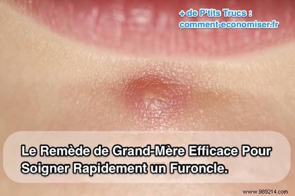 Heal Boils Naturally: Time-Tested Grandmother s Magnesium Chloride Remedy