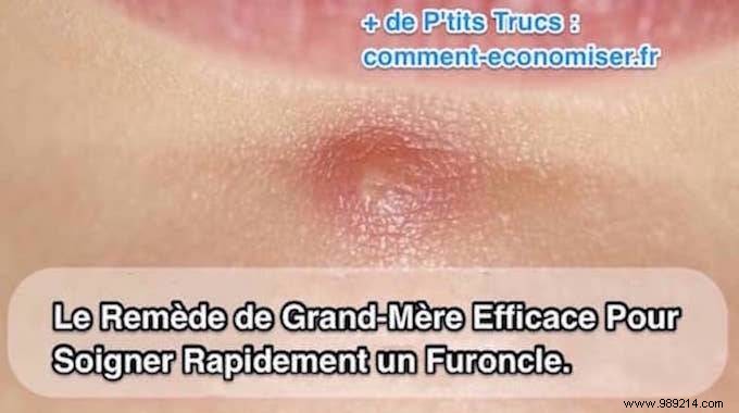 Heal Boils Naturally: Time-Tested Grandmother s Magnesium Chloride Remedy