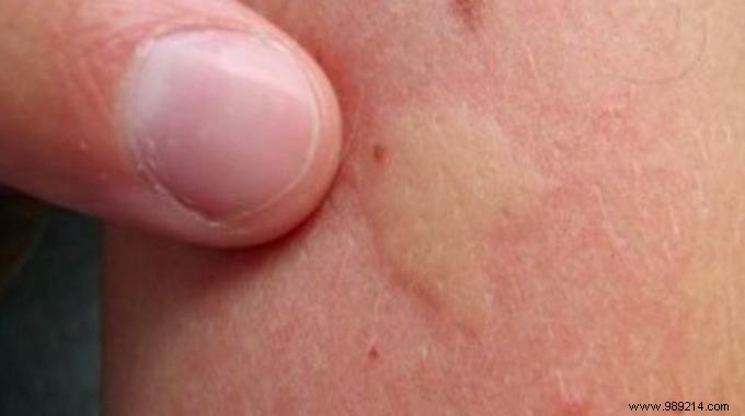 12 Proven Home Remedies to Instantly Soothe Mosquito Bites