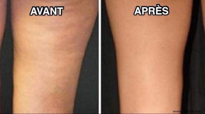 16 Proven Natural Remedies to Reduce Cellulite Effectively